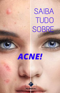 Saiba Tudo Sobre ACNE!